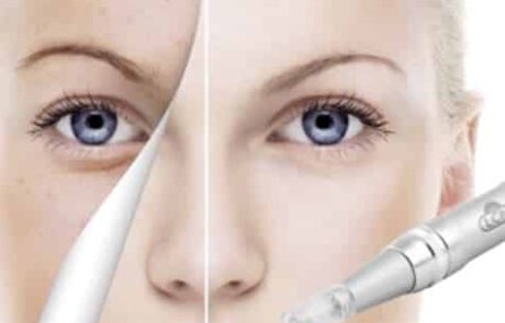 Microneedling de Dakar Kosmetikstudio Hannover
