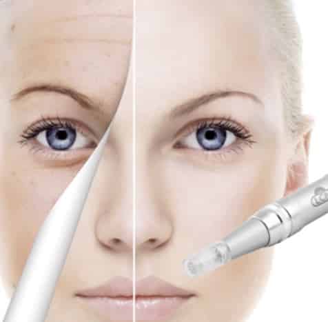 Microneedling Hannover